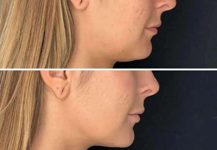 Före- och efterbilder som visar effekten av fillers i ansiktet, med en tydligare käklinje och fylligare kinder.