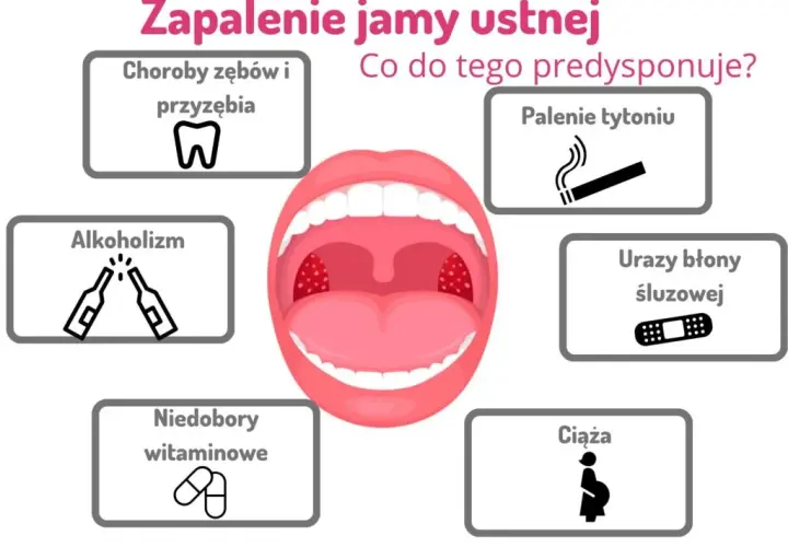 Zapalenie jamy ustnej: Szybkie sposoby, leki i kiedy iść do lekarza