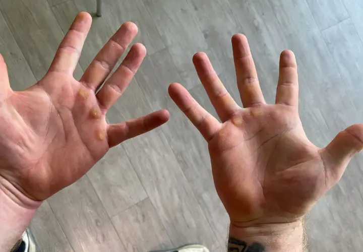 Manos con callos visibles, evidencia de trabajo duro o entrenamiento.