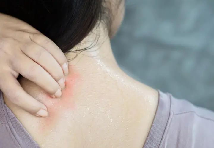Mano che si gratta la nuca e il collo, con arrossamento e sudore. Un fastidioso prurito dietro la nuca e collo.