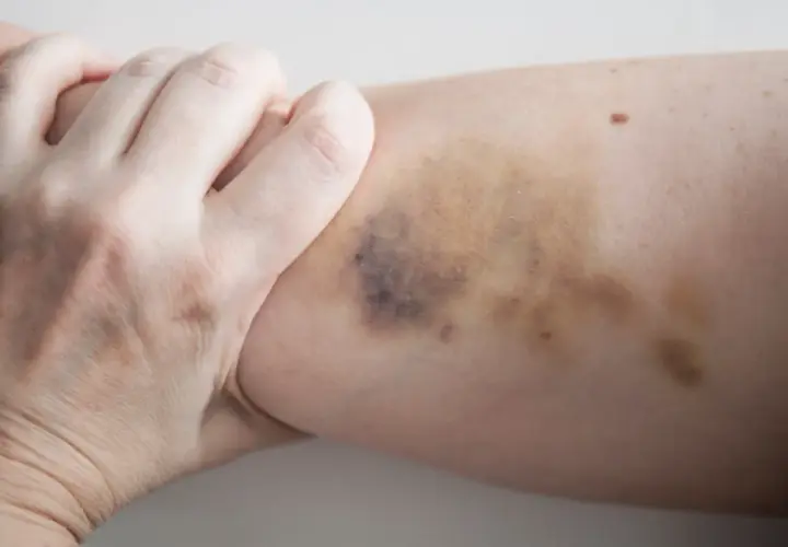 Eine Hand greift nach einem Bein mit dunklen Flecken, die auf einen Sturz oder Stoß hindeuten.