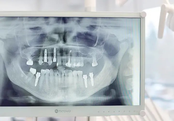 RTG zęba: Co naprawdę widzi dentysta? Ukryta próchnica i torbiele