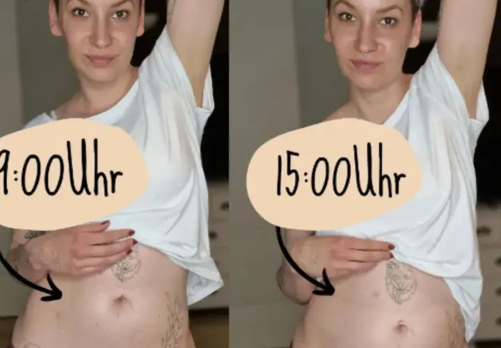 Endometrioza brzuch jak balon – przyczyny wzdęć i skuteczne metody łagodzenia