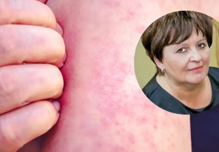 Dłoń drapiąca zaczerwienioną skórę z wysypką. W tle kobieta, być może cierpiąca na tę chorobę.