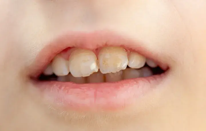 Jak wyleczyć próchnicę bez dentysty i uniknąć bólu zębów