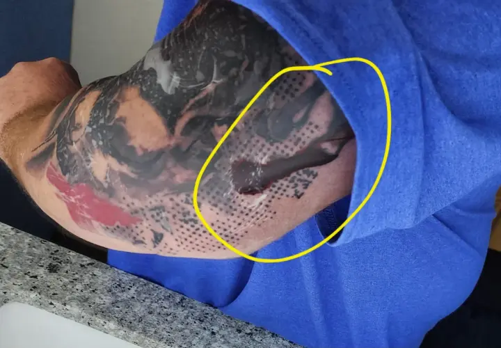 Odparzenie po second skin na ręce z tatuażem. Widoczny płyn i zaczerwienienie pod folią.