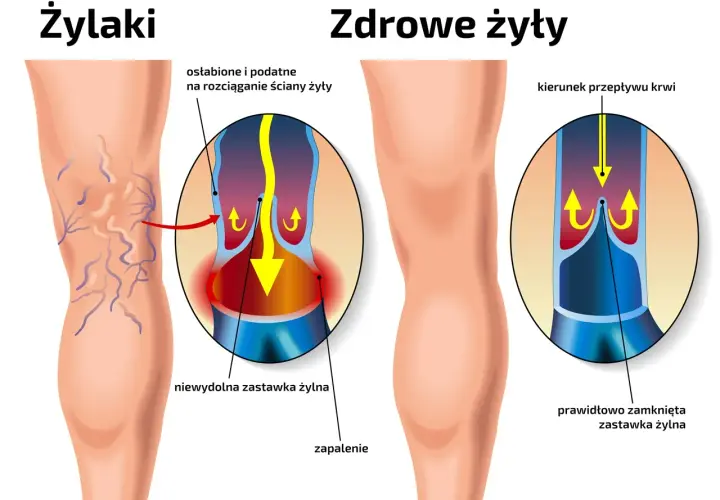 Porównanie nóg z żylakami i zdrowych. Ilustracja pokazuje, jak bieganie wpływa na żyły, zapobiegając powstawaniu żylaków.