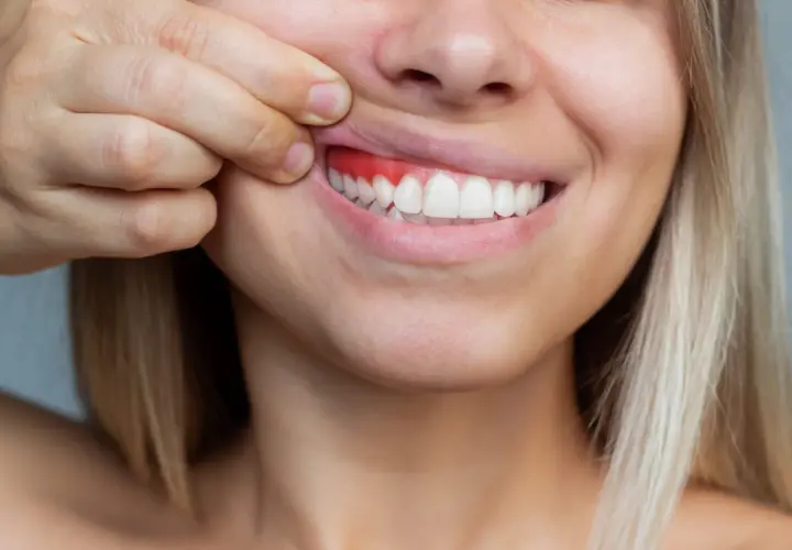 Una persona se tira del labio superior para mostrar sus encías, que están rojas e inflamadas, indicando la falta de encias sanas.