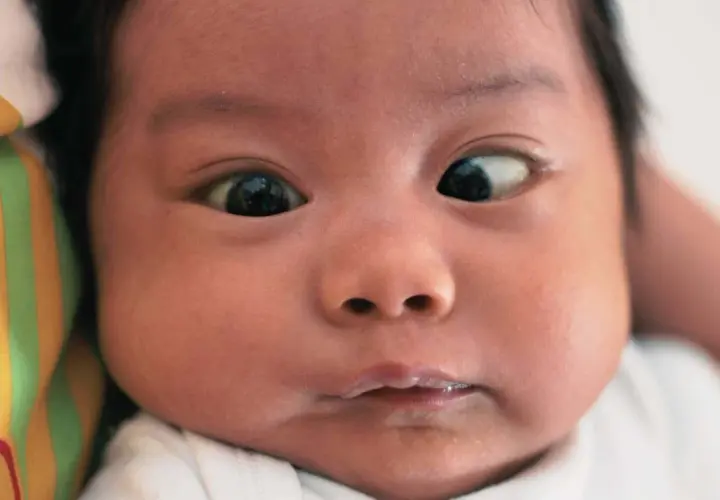 Primo piano di un neonato con strabismo. Un occhio guarda dritto, l'altro è deviato verso l'esterno.