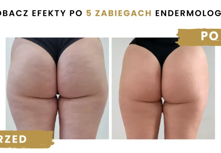 Endermologia: co to, jak działa i czy warto? Pełny przewodnik