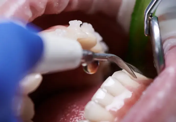Dettaglio di una pulizia denti professionale con strumento odontoiatrico.