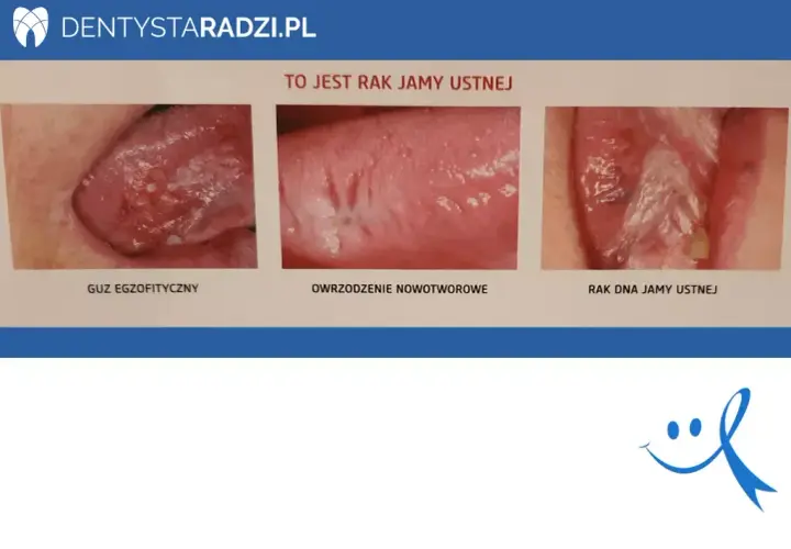 Rak dziąseł: jak wygląda? Zdjęcia i objawy, które musisz znać
