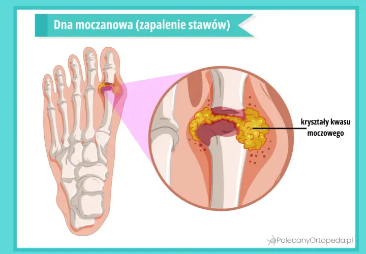Dna moczanowa: zapalenie stawu palucha z kryształami kwasu moczowego. Jakie badania pomogą zdiagnozować problem?