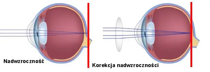 Maksymalna wada wzroku: co musisz wiedzieć o dioptriach i ich skutkach