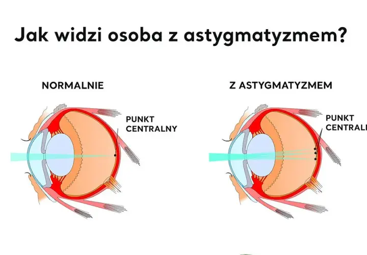 Cylindry w soczewkach: co to jest i jak wpływają na wzrok?