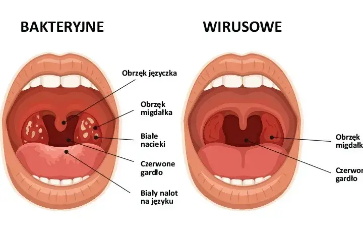 Jakie są objawy anginy bakteryjnej i wirusowej? Charakterystyczne oznaki