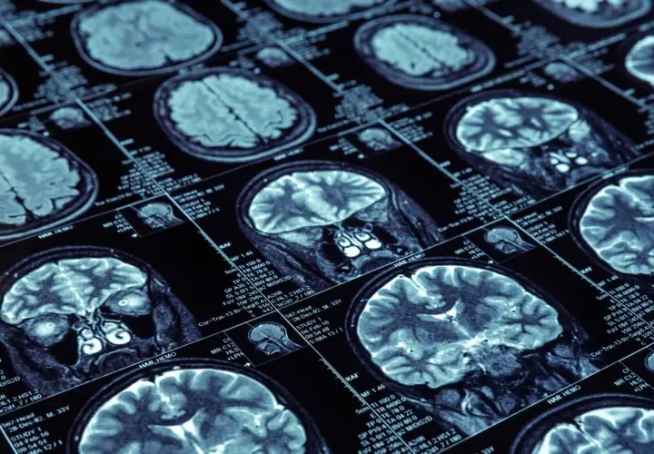 Jak zapobiec Alzheimerowi: Skuteczne metody na zmniejszenie ryzyka