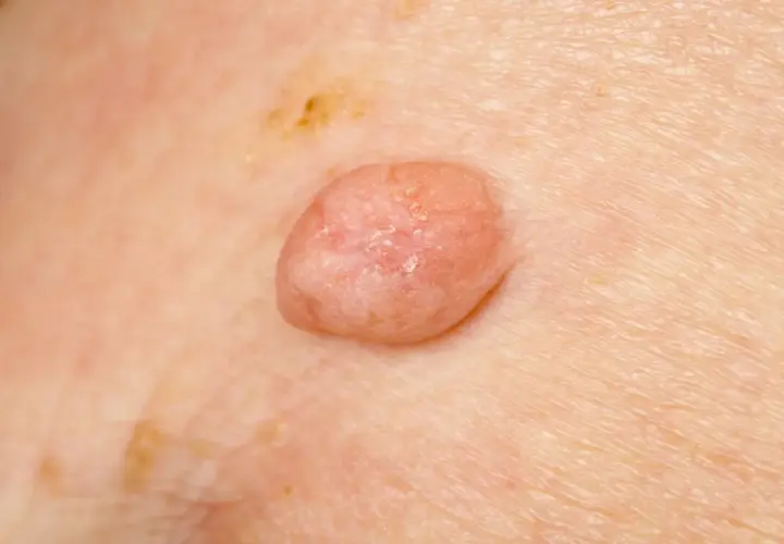 Wirus HPV: objawy i zdjęcia – jak rozpoznać kłykciny i brodawki?