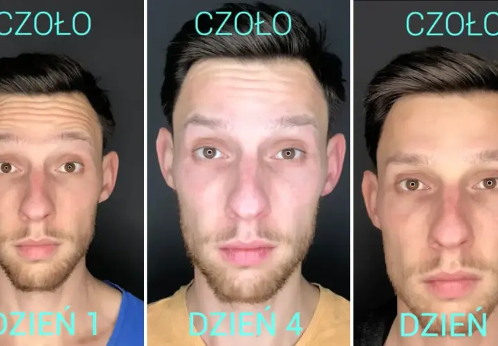 Botoks na lwia zmarszczkę: efekty i czas oczekiwania na rezultaty