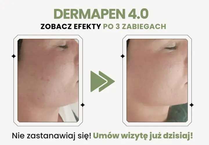 Przed i po zabiegu Dermapen 4.0: widoczne dermapen efekty po 3 zabiegach, skóra wygładzona, bez niedoskonałości.