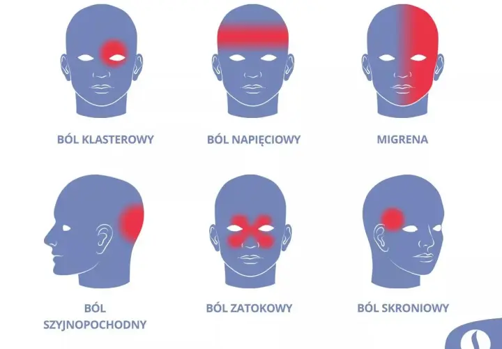 Ilustracja pokazuje lokalizację bólu głowy: klasterowego, napięciowego, migreny, szyjnopochodnego, zatokowego i skroniowego.