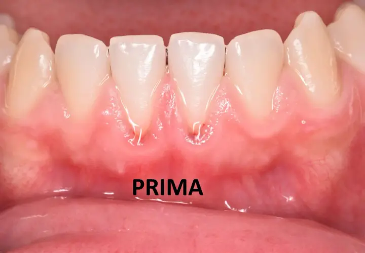 Gengive infiammate e arrossate intorno ai denti anteriori, con segni di recessione gengivale. La parola "PRIMA" indica la situazione iniziale.