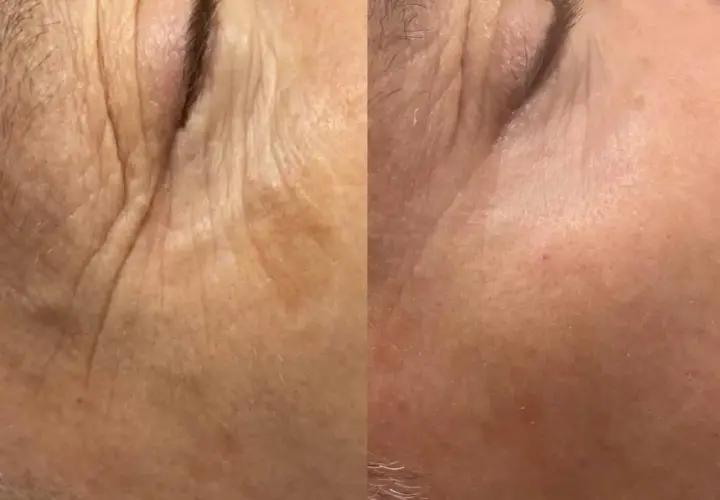 Split image showing before and after of skin treated with fractional CO2 laser, with reduced wrinkles.