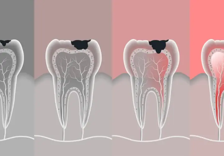 Ilustración muestra cómo es una caries dental, desde una pequeña mancha negra hasta una infección avanzada con pus.