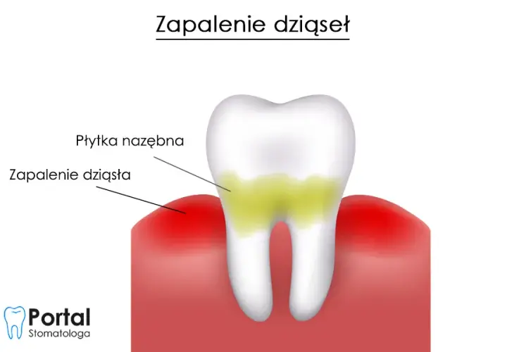 Zapalenie dziąseł? Jak skutecznie leczyć w domu i u dentysty