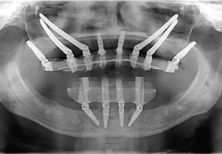 Radiografia panoramica mostra impianti dentali posizionati in arcate mascellari con ridotta quantità di osso, una soluzione per chi necessita di impianti dentali senza osso.