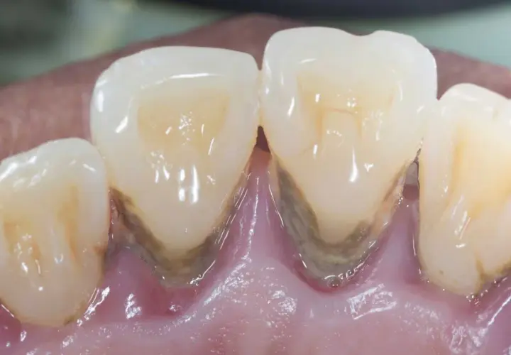 Denti con evidente accumulo di tartaro e infiammazione gengivale, segni di paradontosi dentale.