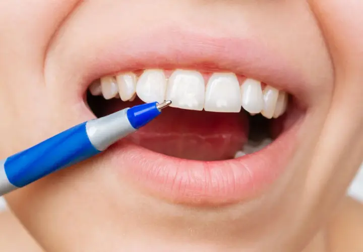 Applicazione di fluoro sui denti con una penna speciale per una protezione duratura.