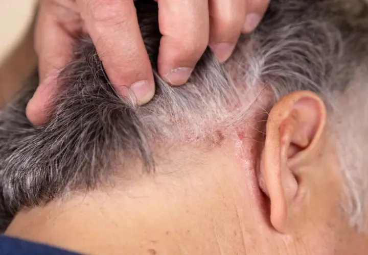 Dedos separan cabello gris mostrando escamas y enrojecimiento, indicando posible tiña en el pelo.