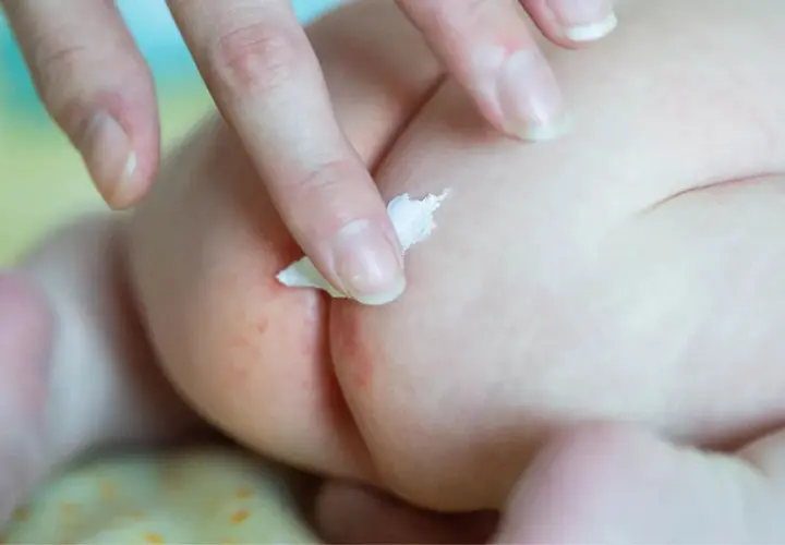 Mano applica crema su piaghe culetto neonato. Come curarla con delicatezza per lenire il rossore.