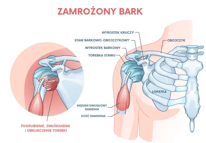 Zamrożony bark: pogrubienie, zwłóknienie i obkurczenie torebki stawu ramiennego wyjaśnia, dlaczego bolą ramiona.