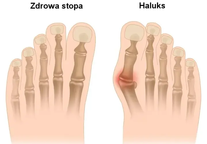 Ból haluksa: dlaczego stopa cierpi i jak znaleźć ulgę?
