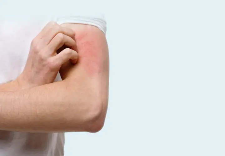 Un bras rouge et irrité se gratte, une sensation de chatouillement sur la peau qui devient insupportable.