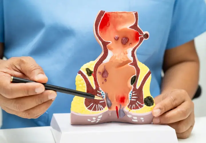 Modello anatomico che illustra emorroidi sanguinanti e altre patologie anali.