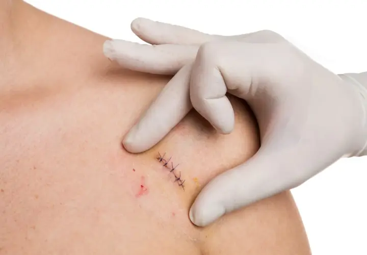 Main d'un professionnel en gant blanc examinant une plaie suturée, préparant l'ablation des points de suture.