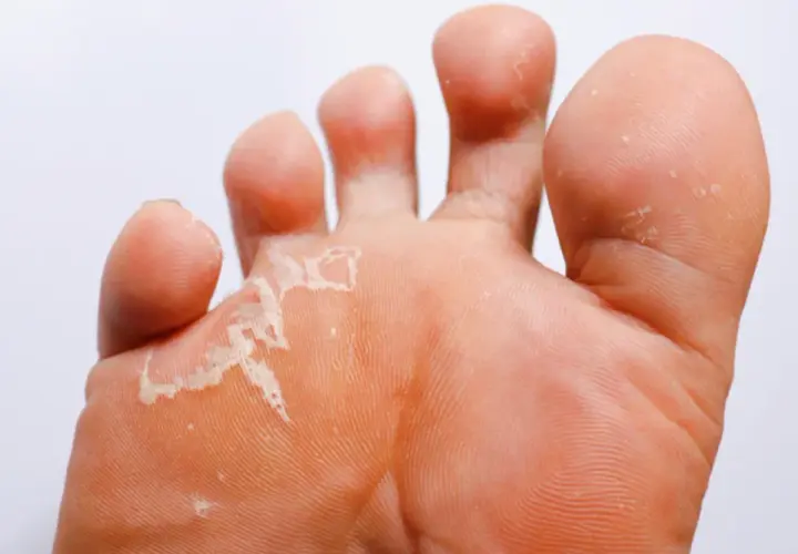 Le pied de l'athlète montre une peau qui pèle entre les orteils, signe d'une mycose.