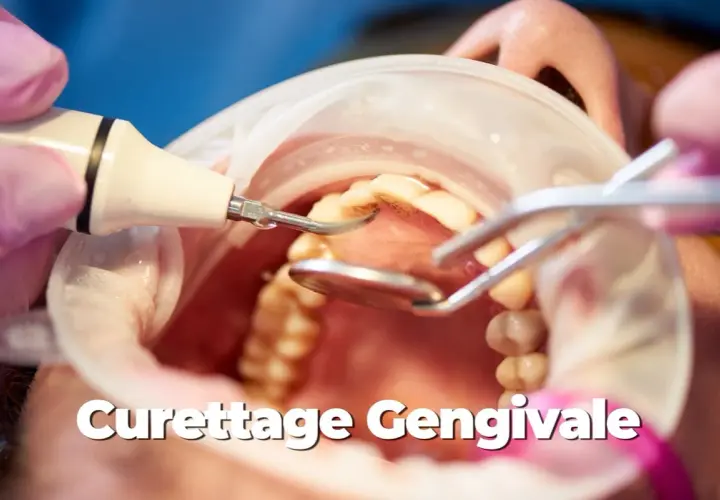 Dettaglio di una pulizia sottogengivale con strumento a ultrasuoni e specchietto dentale.