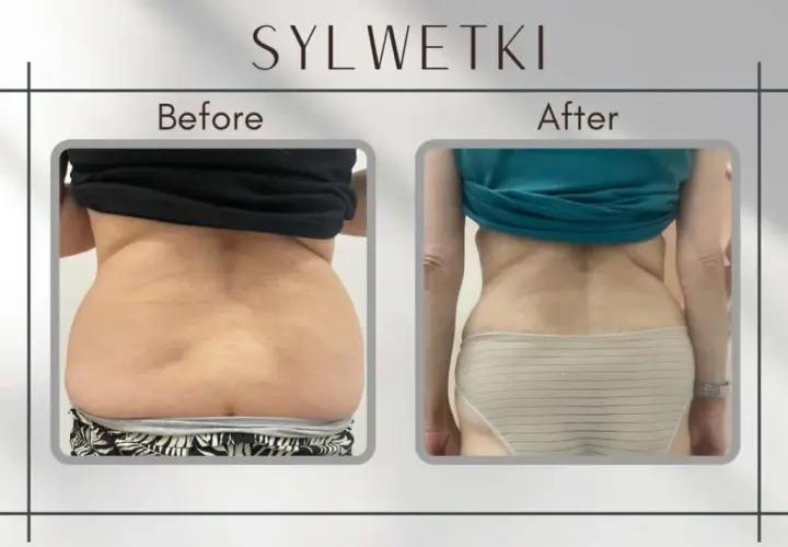 Liposukcja: co to? Modelowanie sylwetki, metody, ceny ekspert radzi