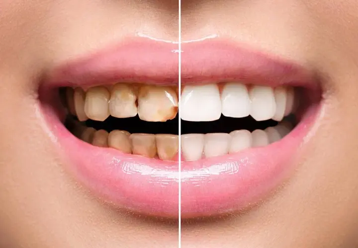 Sorriso diviso: da denti ingialliti e con placca a bianchi e splendenti.