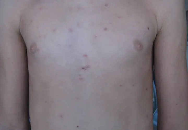 Torace con lesioni cutanee rosse e pruriginose, indicative di pitiriasi lichenoide cronica.