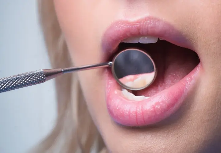 Usta kobiety z otwartymi zębami, w których odbija się lusterko dentystyczne. Widoczny brak szkliwa na zębach.