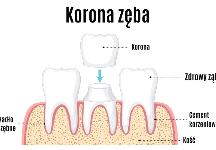 Ilustracja pokazuje proces zakładania korony tymczasowej na ząb. Widoczne są zdrowe zęby, cement korzeniowy i kość.