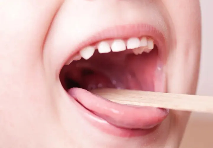 Bocca di bambino aperta con linguetta di legno per controllare la gola. Informazioni sulla faringite bambini quanto dura.