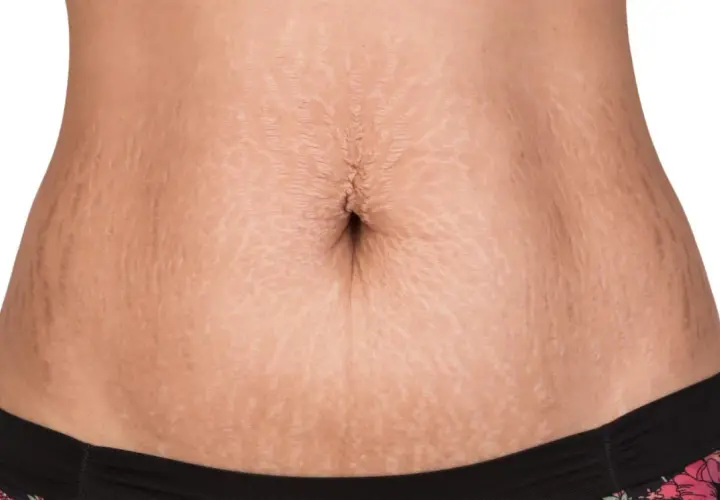 En mage med bristningar, en vanlig syn efter graviditet. Många väljer en mommy makeover för att återfå sin kropp.
