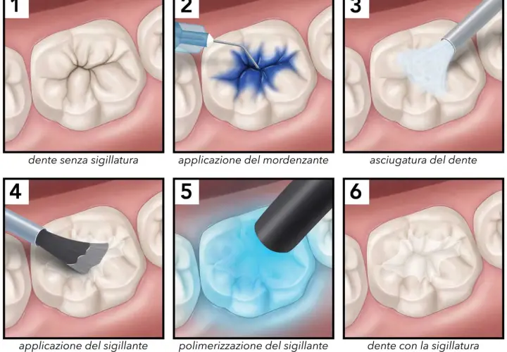 Illustrazione dei passaggi per sigillare i solchi dei denti, dalla preparazione all'applicazione del sigillante.