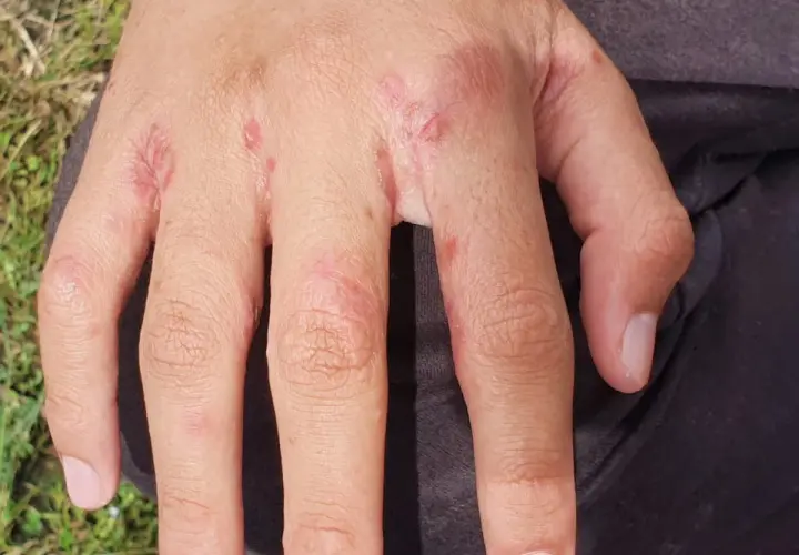 Här ser du hur skabb utslag kan se ut på händerna: små röda prickar och irriterad hud mellan fingrarna.